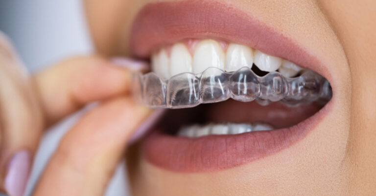 invisalign em goiania